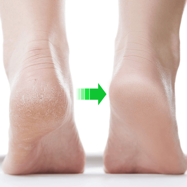 Strømpe mod revner i hælen - HeelPad